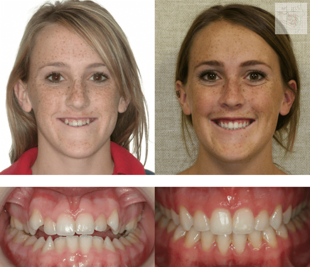 orthodontics-braces-before-and-after-01