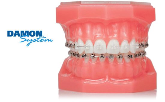 damon-braces-model.jpg
