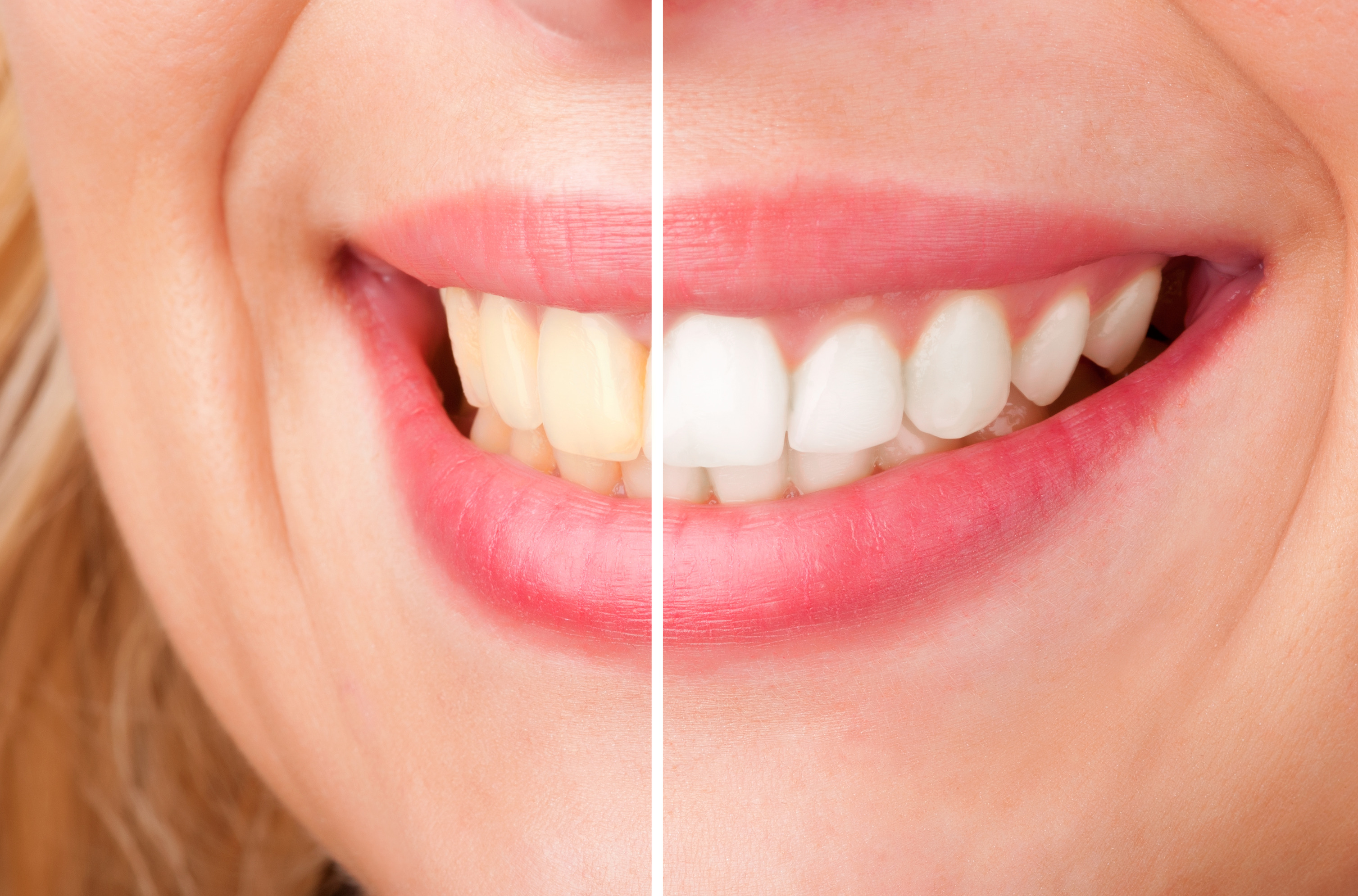 Bleaching - Berapa Harga Memutihkan Gigi di Dokter Gigi? Yuk, Simak Pembahasannya