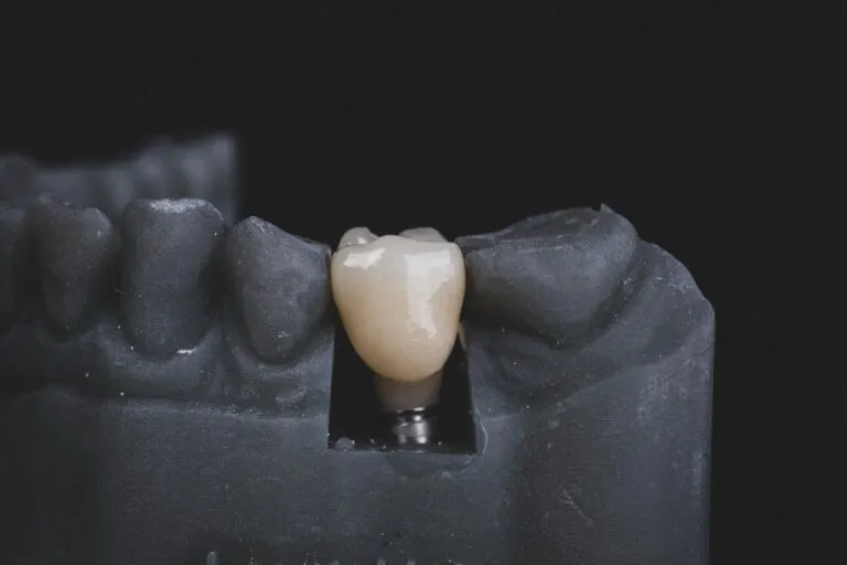 Pro dan Kontra Melakukan Pemasangan Implant Gigi
