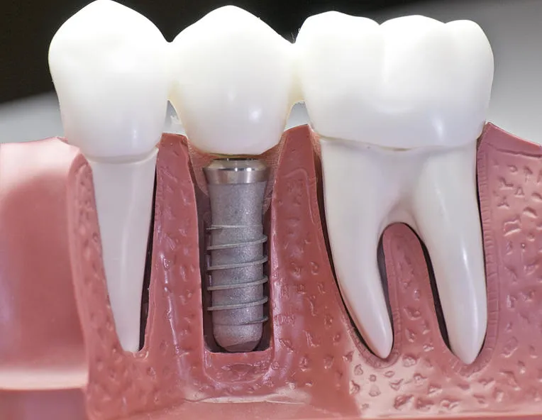 Perbedaan Gigi Palsu Permanen dan yang Bisa Dilepas