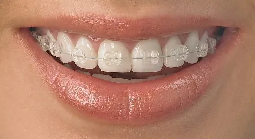 Kelebihan dan Kekurangan Behel Transparan Ceramic