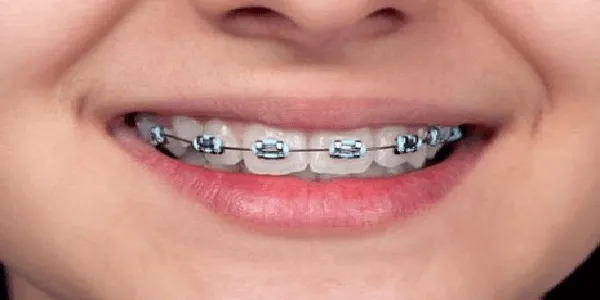 Harga Pasang Behel Terjangkau Ya Orange Dental Tempatnya