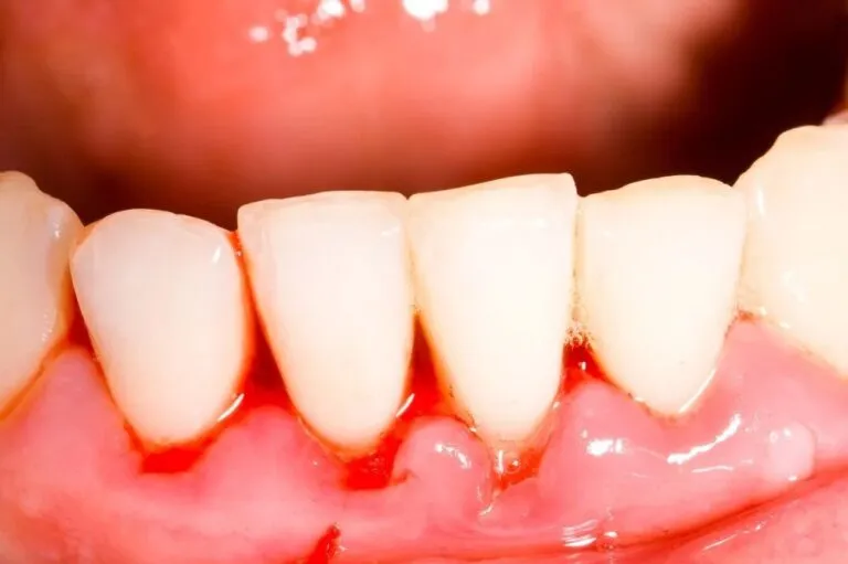 Gingivitis, Penyebab Gusi Sakit yang Sering Diabaikan