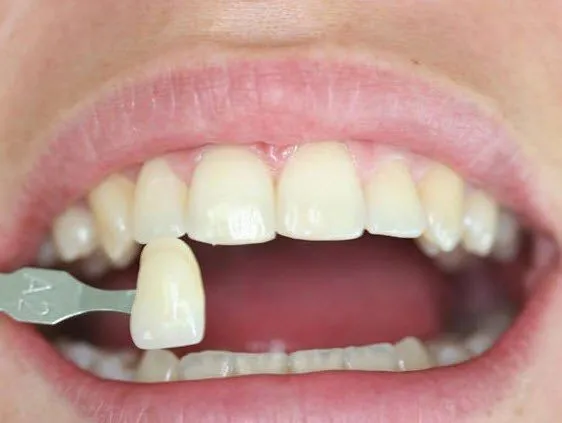 Ini Dia Faktor Pengaruh Harga Veneer Gigi