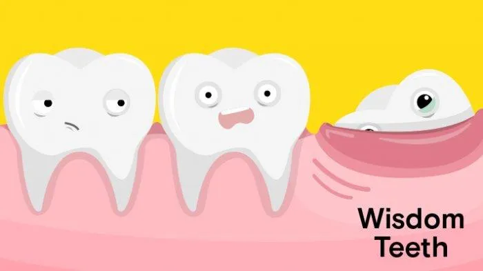 7 Hal Penting Mengenai Gigi Bungsu Wajib Kamu Tau Sebelum Operasi