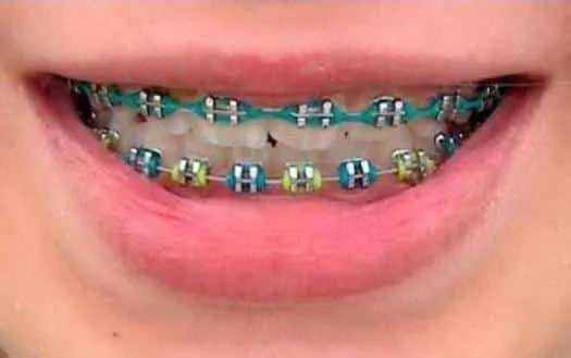 Update Warna Karet Behel yang Lagi Trend