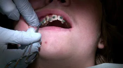Harga Pasang Behel di Dokter Gigi Tidak Lagi Mahal
