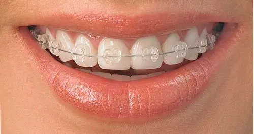 Yuk, Cari Tahu Harga dan Model Behel Yang Pas Buat Kamu!