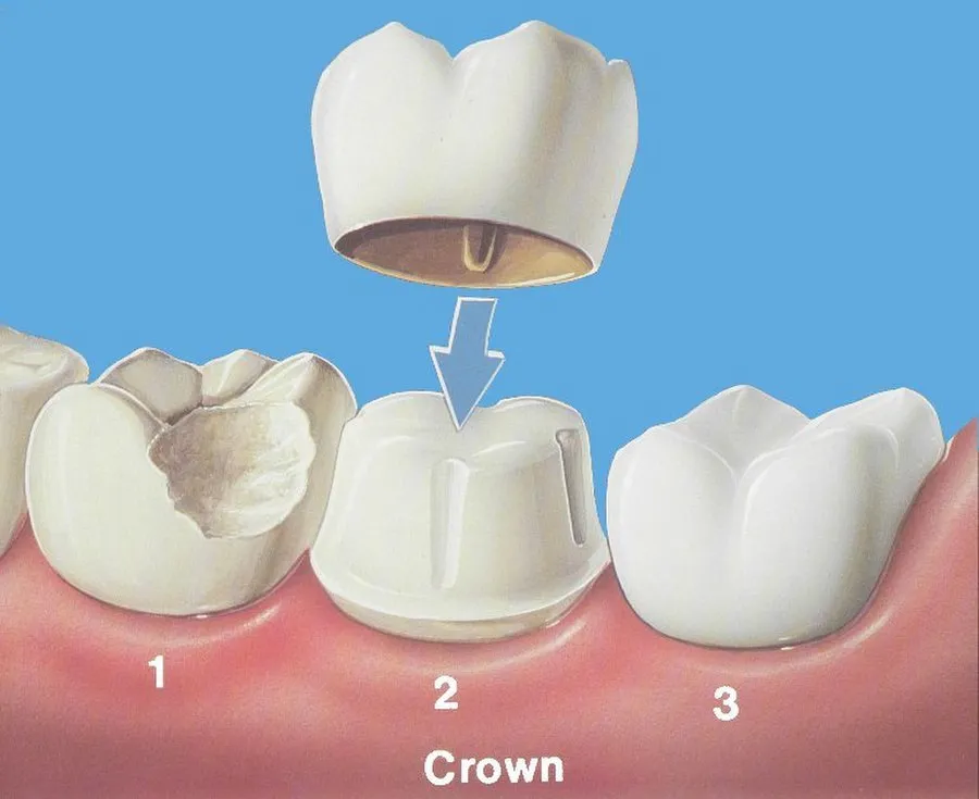 Gigi Palsu Crown