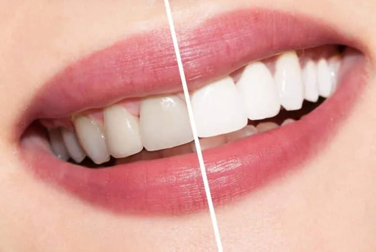 Bleaching Gigi untuk Pemutihan Gigi