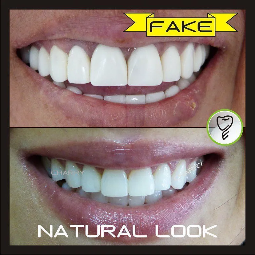 Veneer yang Tidak Terlihat Natural