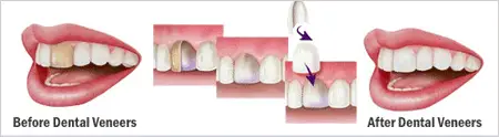 Klinik Veneer Gigi Kelinci Murah dan Terpercaya