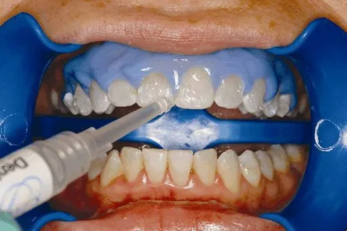 Aplikasi Bahan Bleaching Gigi