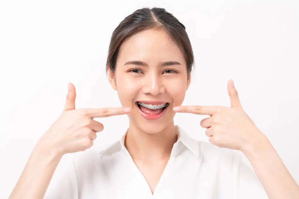 10 Hal Wajib Tau Sebelum Pasang Behel Gigi
