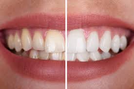 Whitening