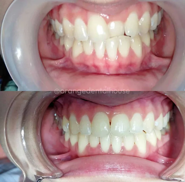 Foto sebelum dan sesudah Behel Gigi di Orange Dental