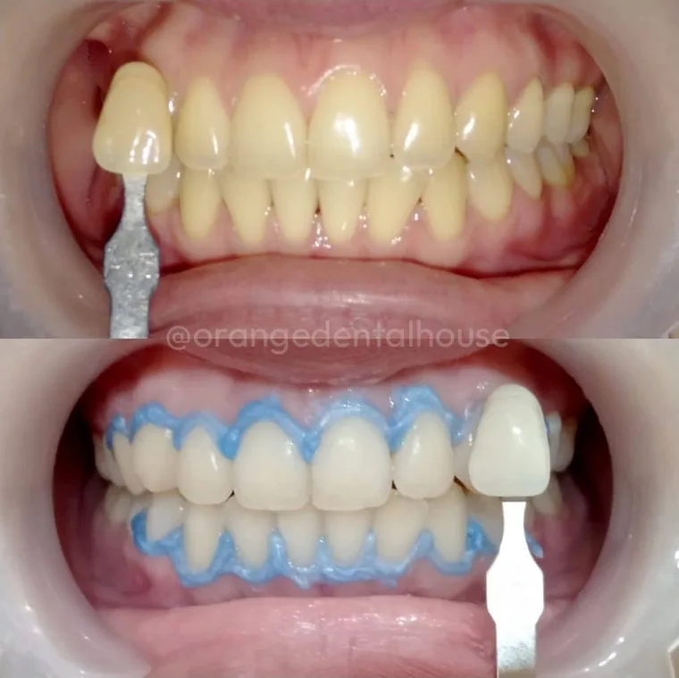 Foto sebelum dan sesudah Bleaching Gigi di Orange Dental