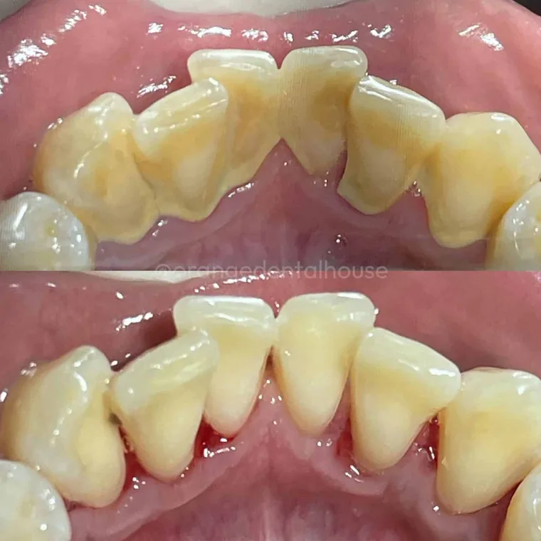 Foto sebelum dan sesudah Scaling Gigi di Orange Dental