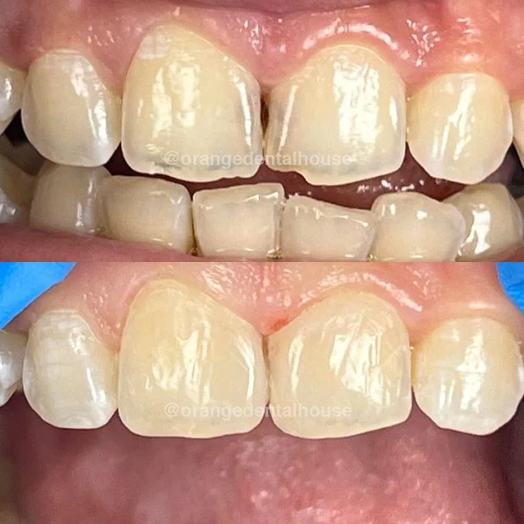 Foto sebelum dan sesudah Tambal Gigi di Orange Dental
