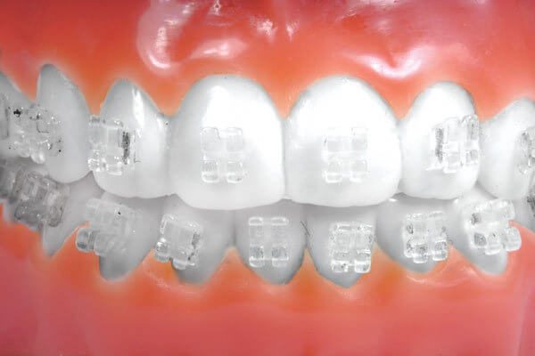  Harga  Behel  Transparan di Dokter Gigi Orange Dental House 