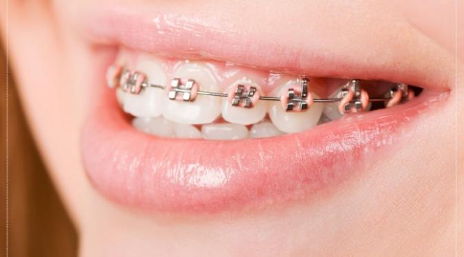  Harga  Behel  Gigi dan Biaya Pemasangannya di Dokter Gigi 