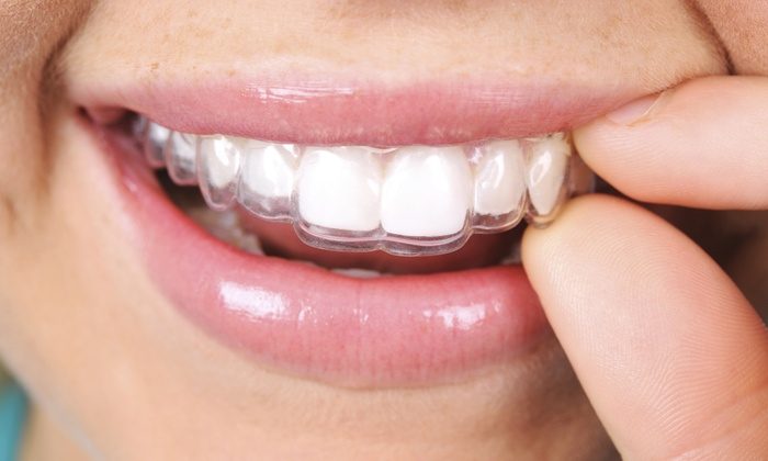 10 Hal Wajib Tau Sebelum Pasang Behel Gigi  Orange Dental 