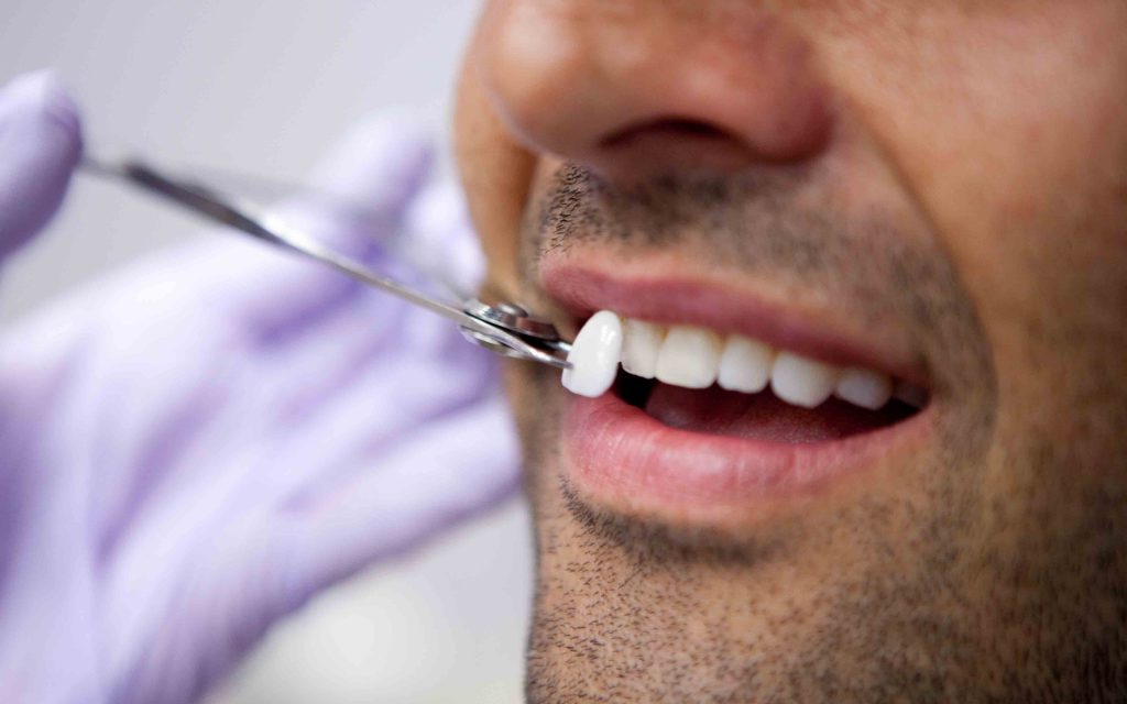 Veneer - Berapa Harga Memutihkan Gigi di Dokter Gigi? Yuk, Simak Pembahasannya