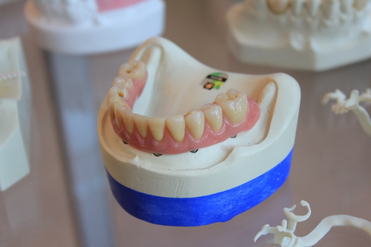 Kekurangan & Kelebihan Gigi Palsu Lepasan Wajib Kamu Ketahui