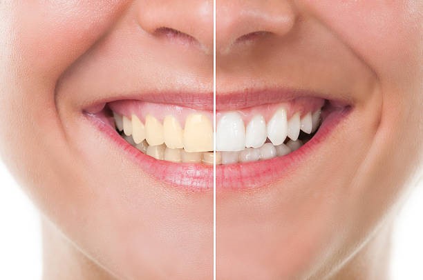 Dental Bleaching; Cara Ampuh Mengatasi Gigi Kuning